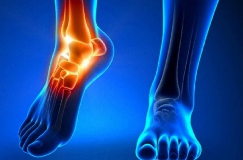 Ο χυμός που διαλύει το ουρικό οξύ στις αρθρώσεις